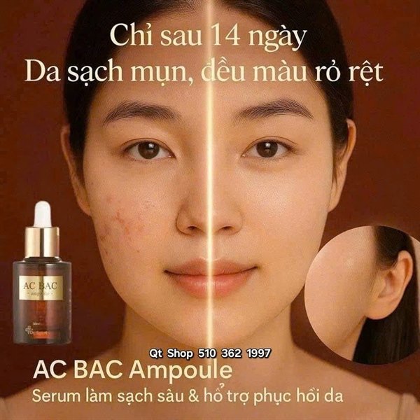 83f5d4f4c79b4324b1c082a0bd574748 Serum trị mụn AC BAC