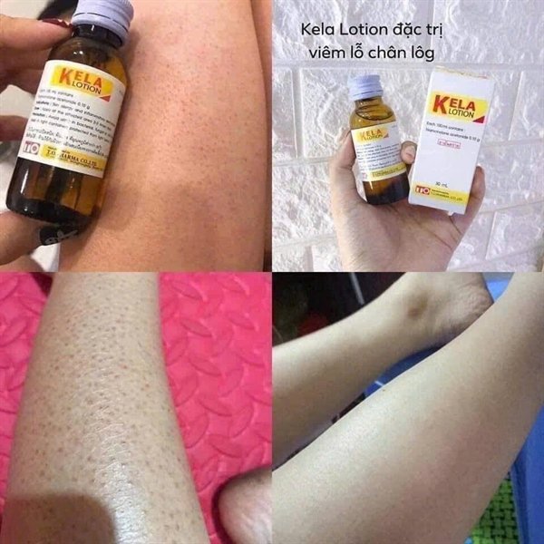 Kela Lotion trị viêm lỗ chân lông LCL Thai Lan - 60ml - EXP 20280522