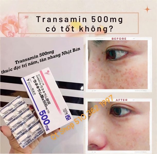 Viên Uống Trị Nám Transamin - 100 viên - Japan - EXP 202709