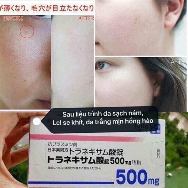 Viên Uống Trị Nám Transamin - 100 viên - Japan - EXP 202709